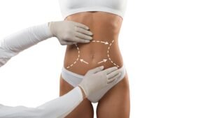 Dr Daniela Correa Cirujana prepararse para una liposucción 1