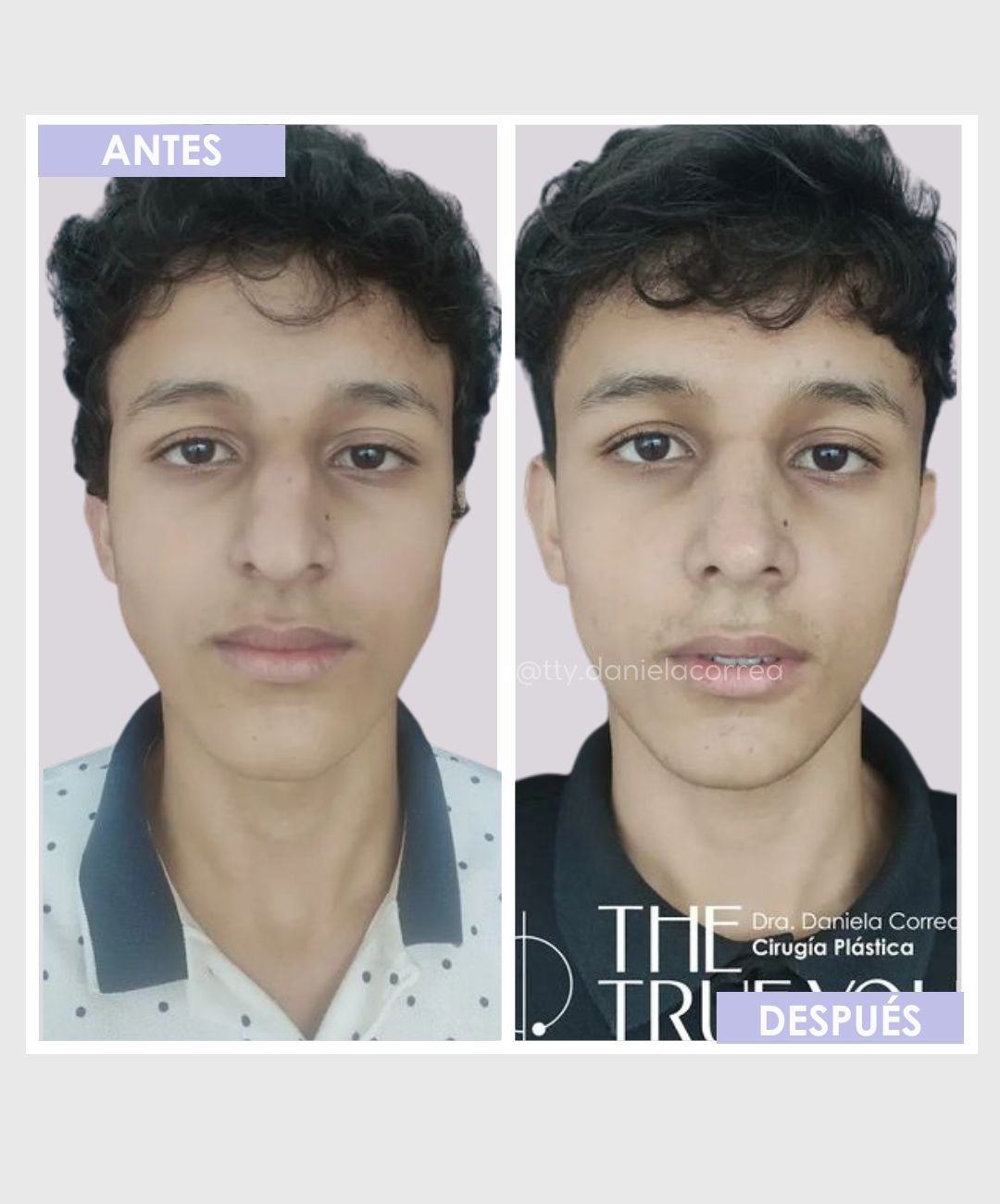 Rinoplastia