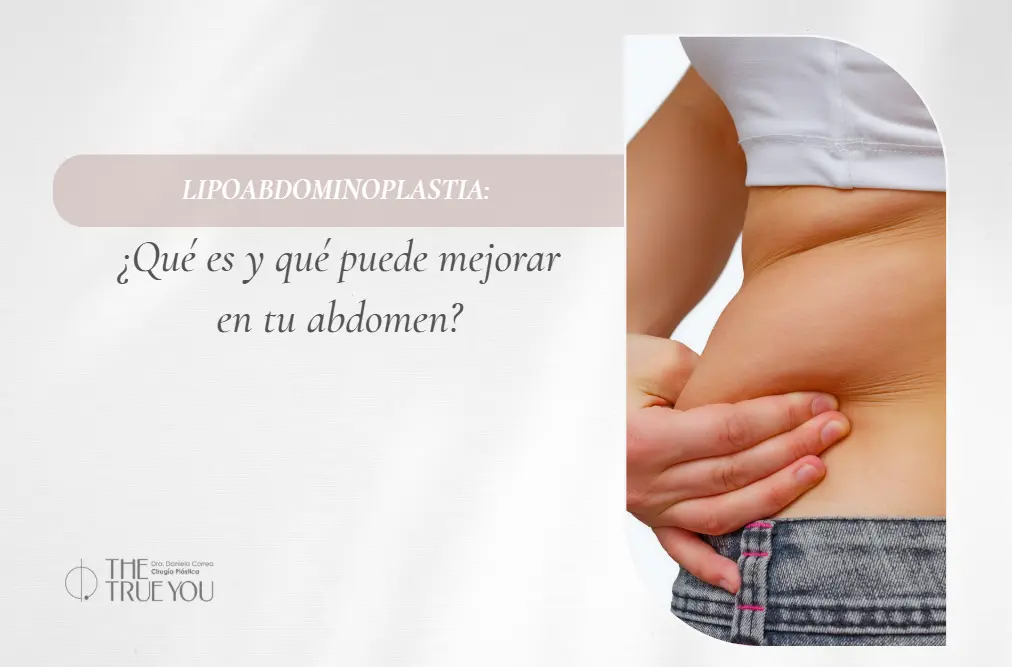 Lipoabdominoplastia en Medellín- Dra. Daniela Correa-Cirujana plástica