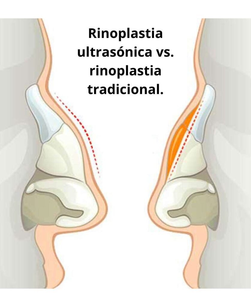 Rinoplastia ultrasónica vs. rinoplastia tradicional