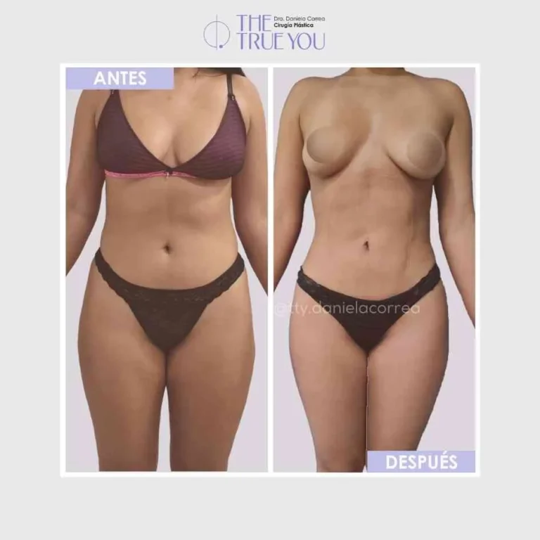 Antes-y-Despues-de-una-Liposucción Dr Daniela Corrrea Cirujana Plástica Medellín