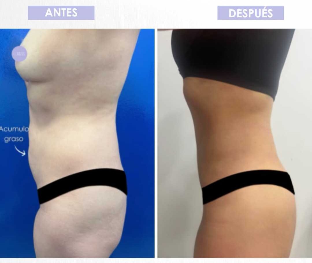 Abdominoplastia antes y después