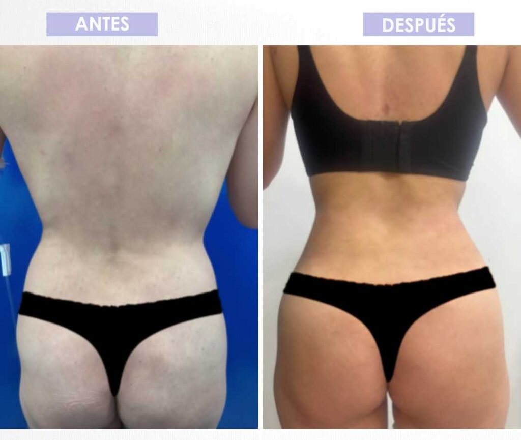 Abdominoplastia antes y después