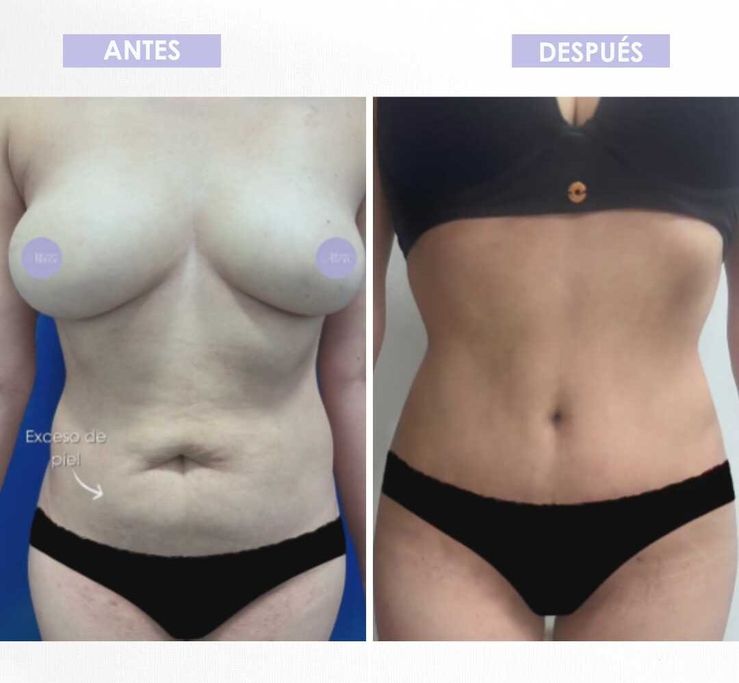 Abdominoplastia antes y después