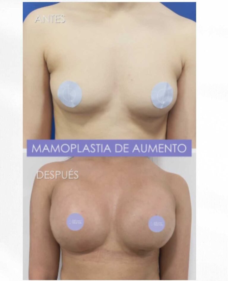 Mamoplastia de aumento antes y después