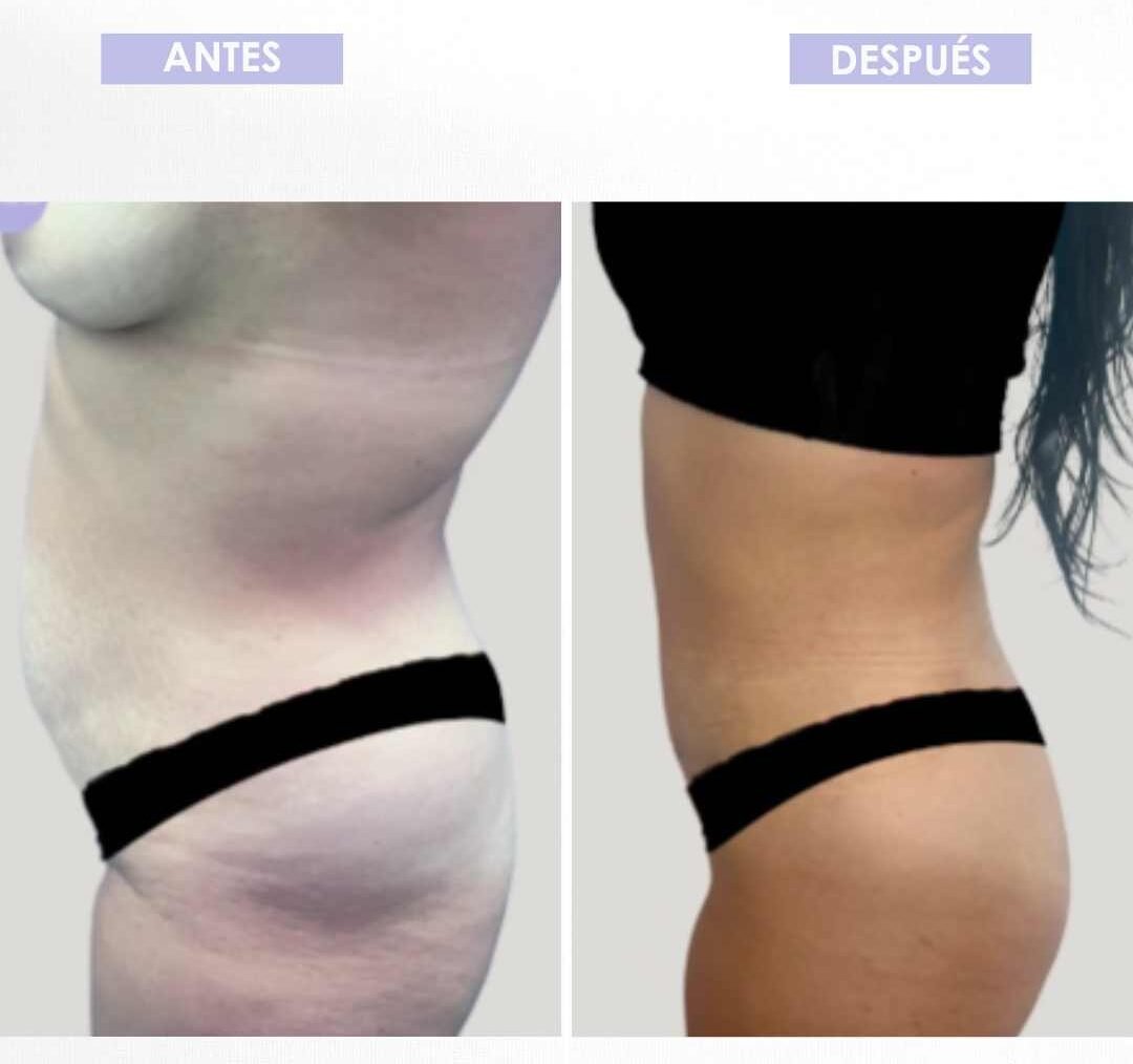 Abdominoplastia antes y después (2)