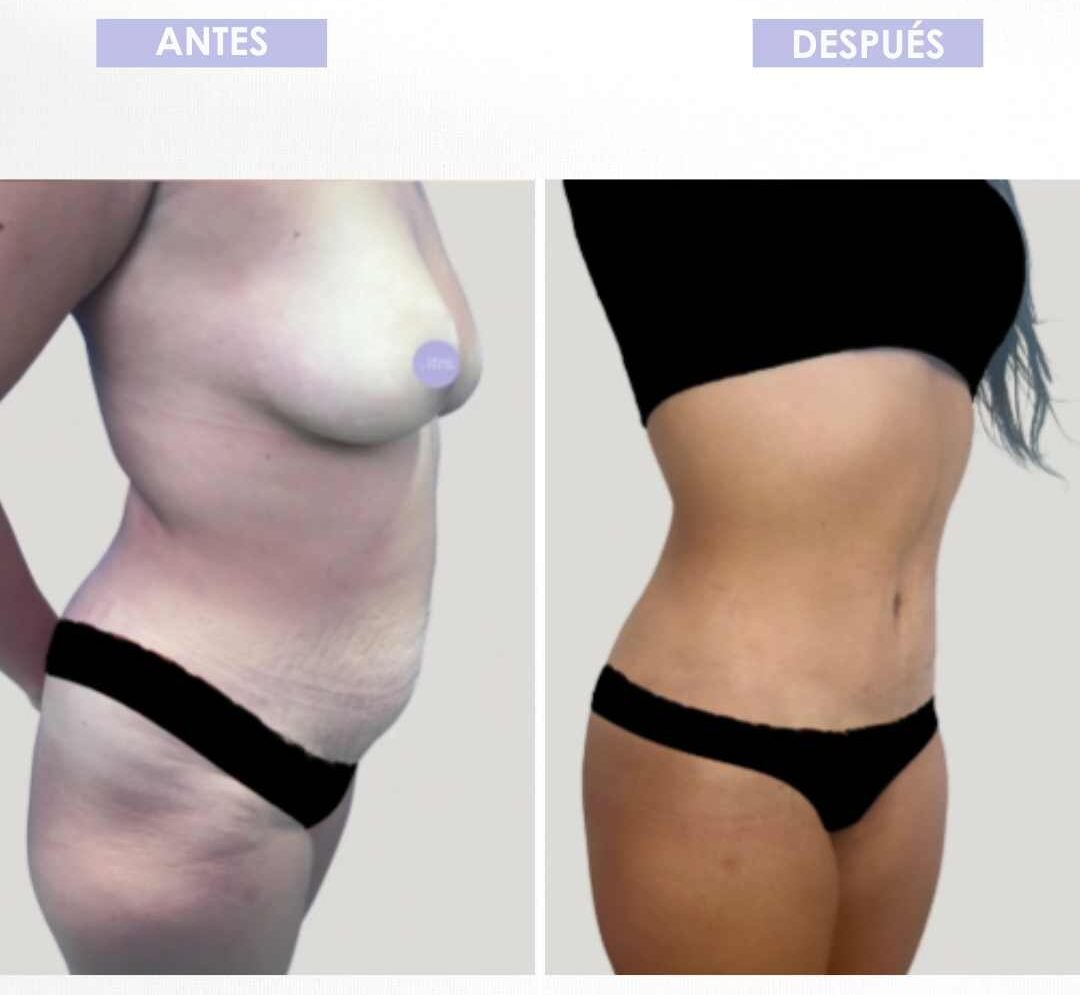 Abdominoplastia antes y después (3)