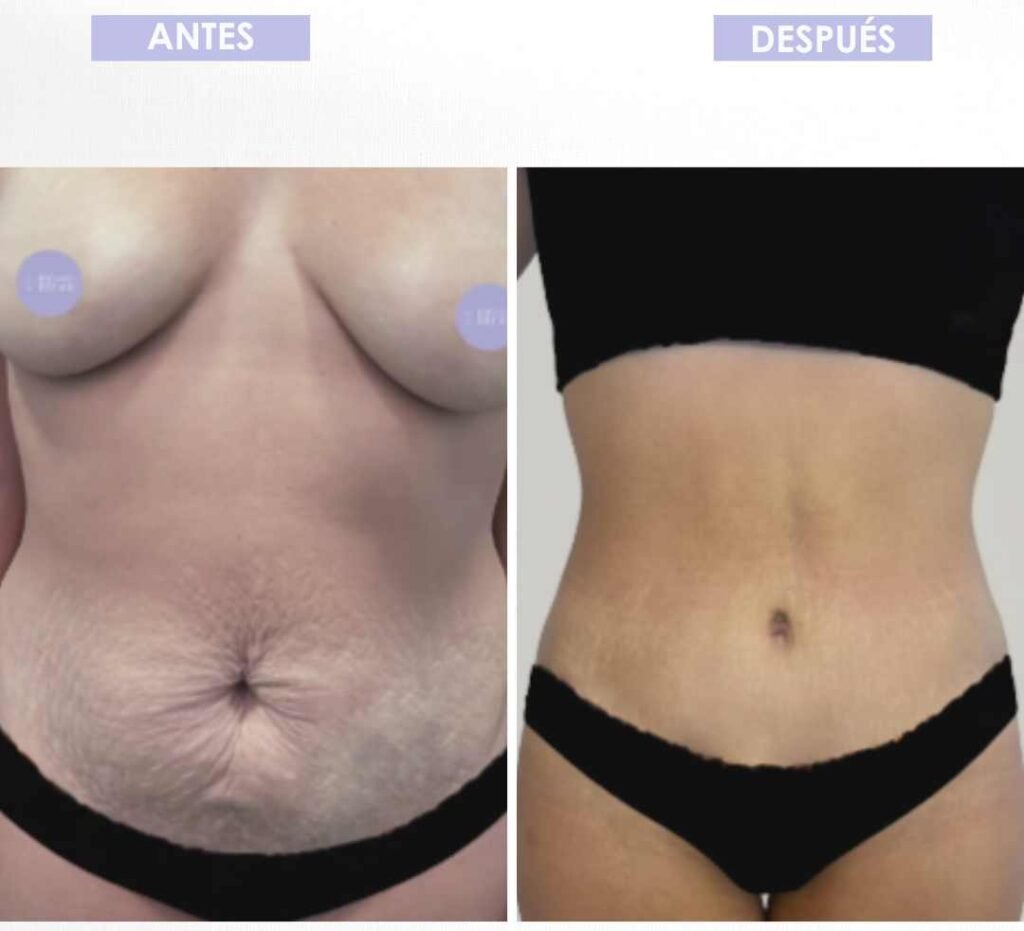 Abdominoplastia antes y después