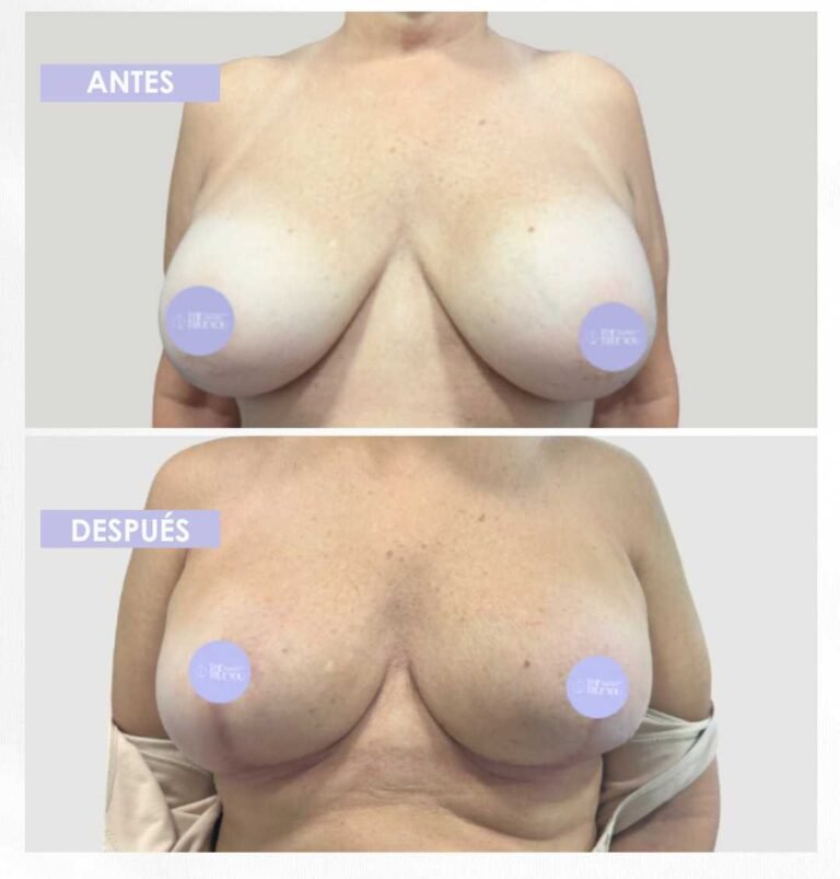Explantación mamaria antes y después