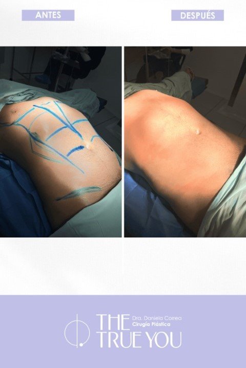 Liposucción antes y después (2)