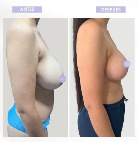 Mamoplastia de reducción antes y después (2)