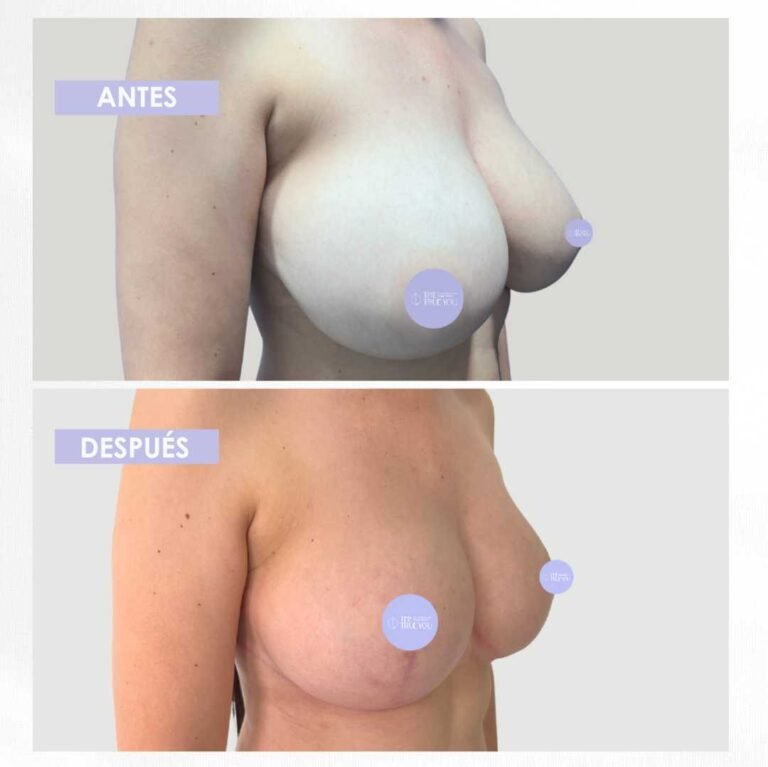 Mamoplastia de reducción antes y después (3)