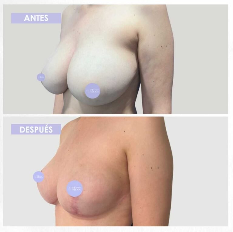Mamoplastia de reducción antes y después (4)