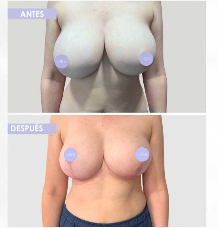 Mamoplastia de reducción antes y después