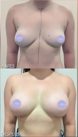 Mamoplastia inframamaria