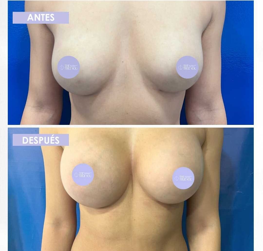 Pexia periareoral antes y después