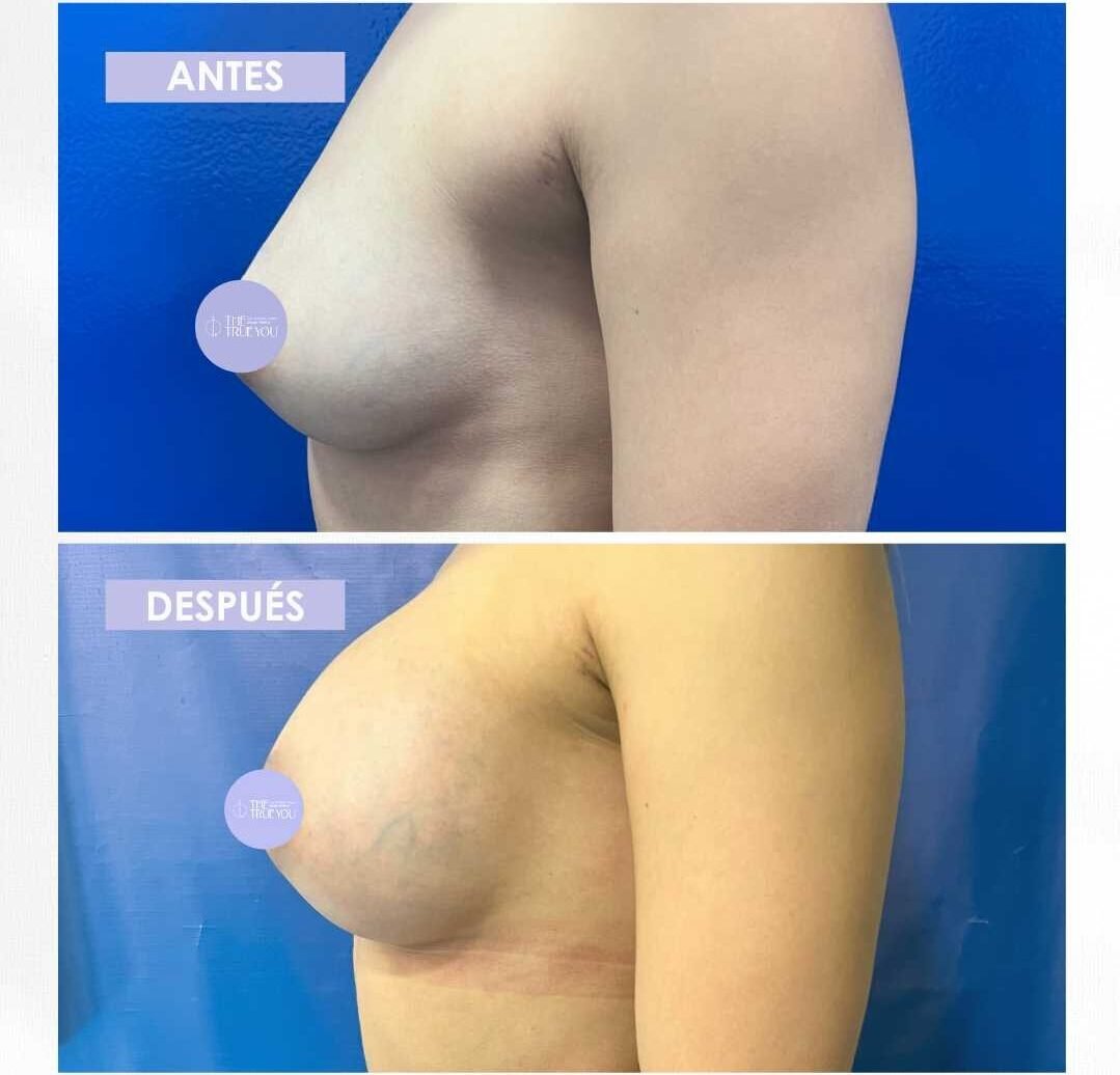 Pexia periareoral antes y después (2)