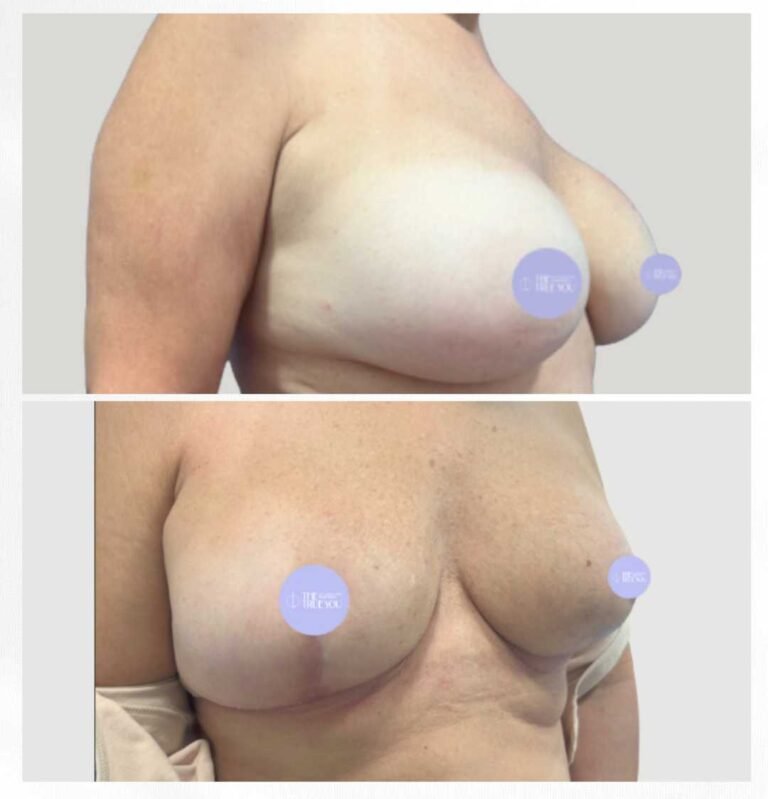 explantación mamaria antes y después (4)