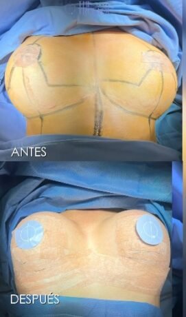 Cambio de prótesis mamarias reducción - Daniela Correa