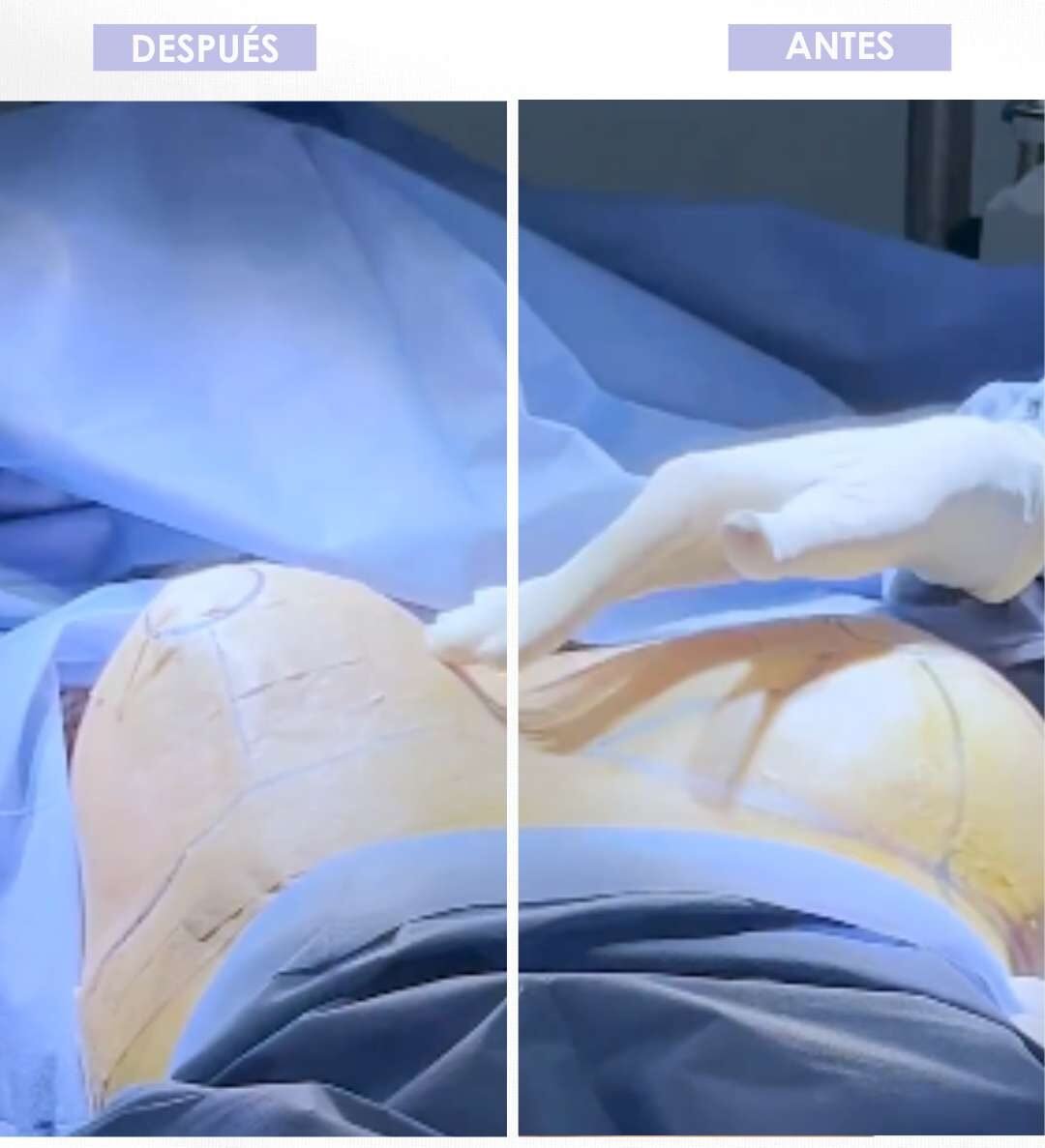 Explantación mamaria por tamaño - Dra. Daniea Correa