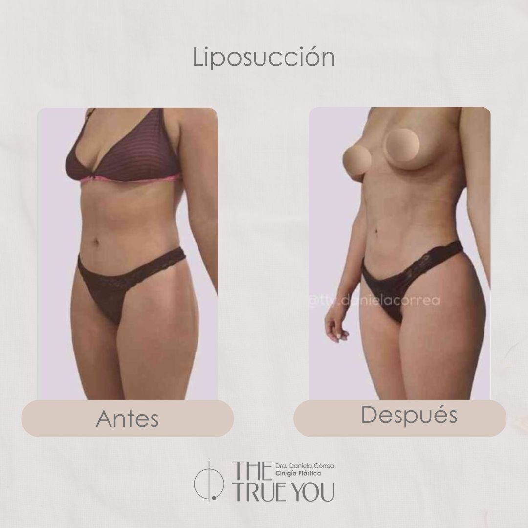 ANTES Y DESPUES DANIELA CORREA - CIRUJANA PLÁSTICA EN MEDELLÍN