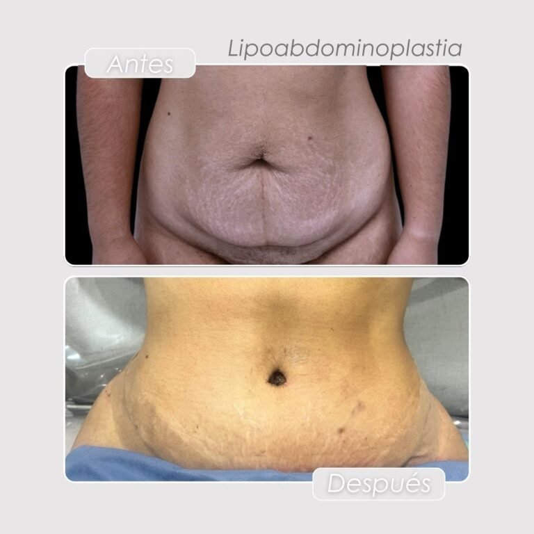 Lipoabdominoplastia Antes y después