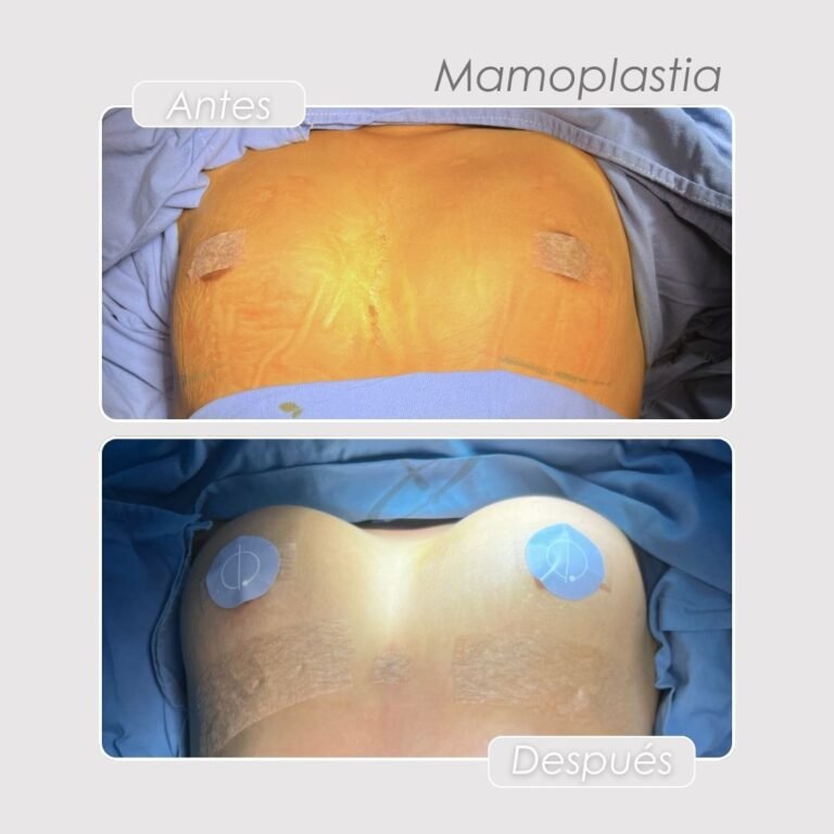 Mamoplastia de aumento antes y después