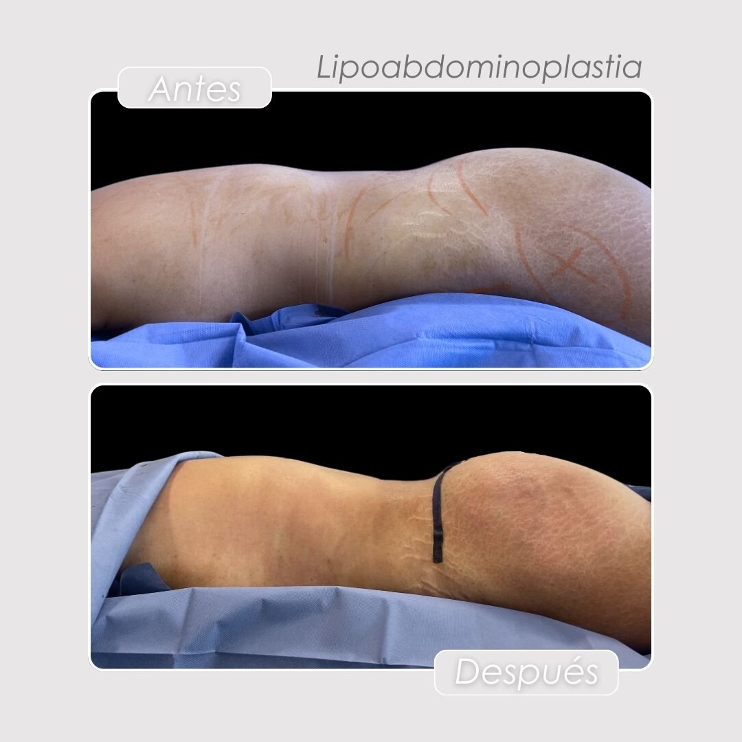 Lipoabdominoplastia Antes y después