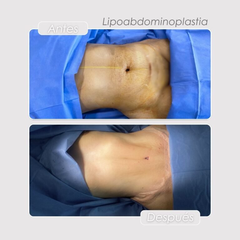 Lipoabdominoplastia Antes y después