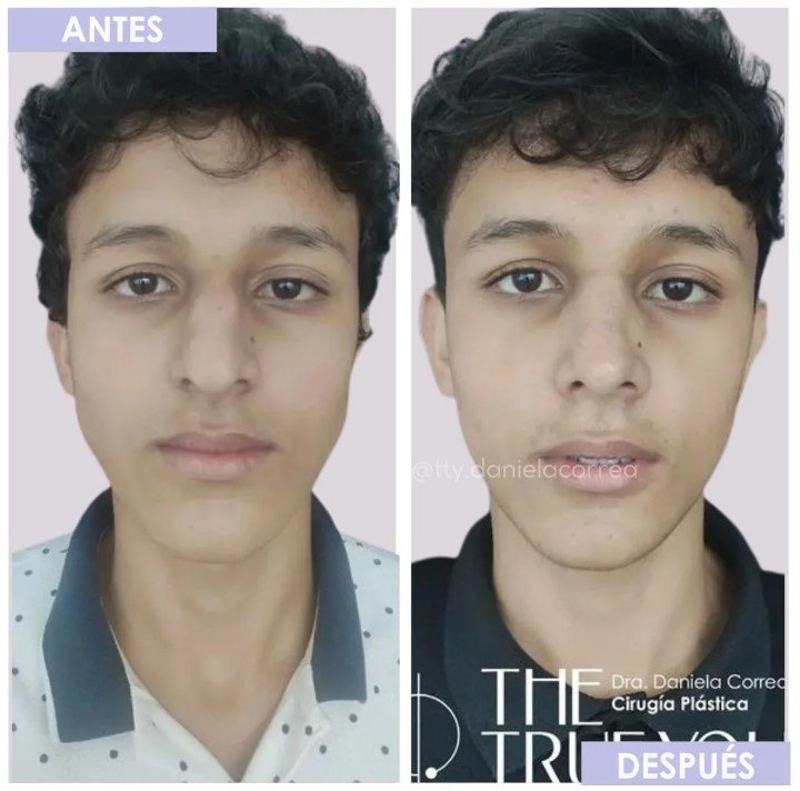 Rhinoplasty before and after male