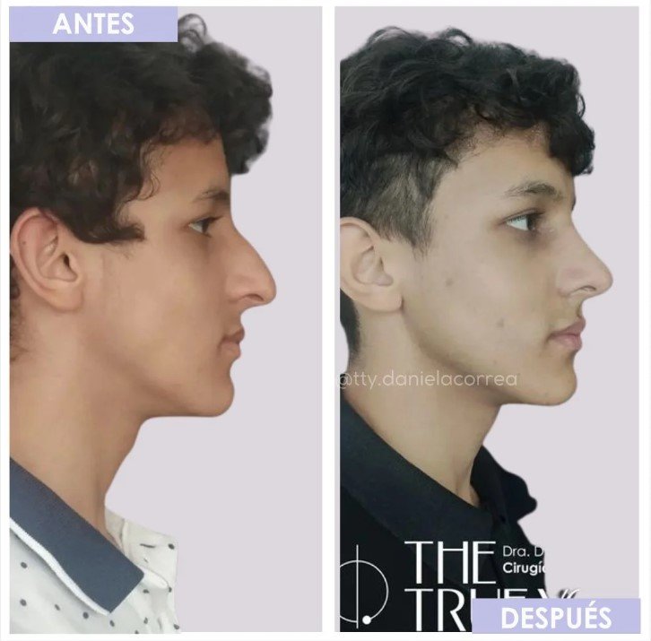 Rhinoplasty before and after