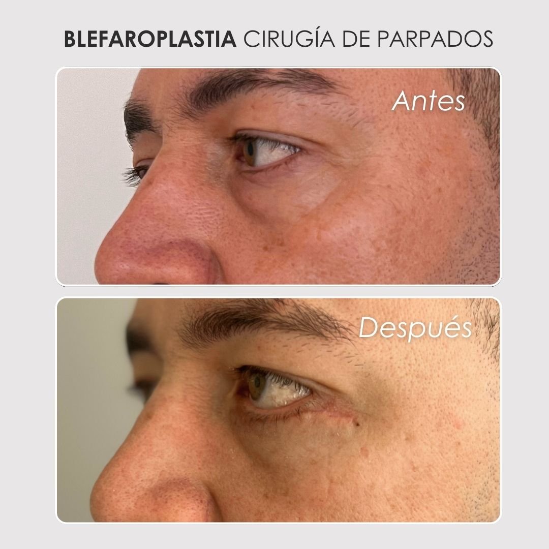 Blefaroplastia Antes y después