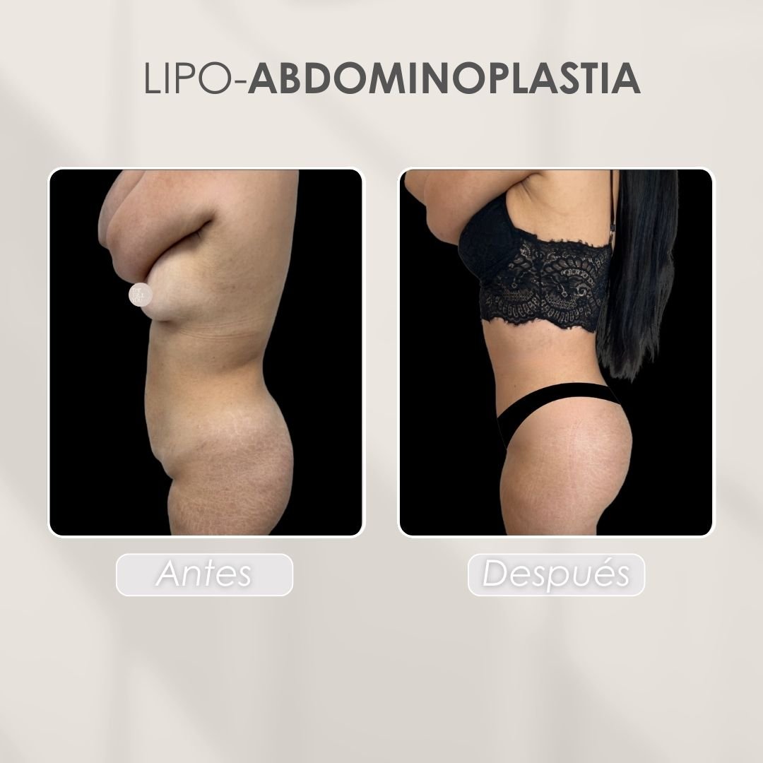 Lipo abdominoplastia Antes y después