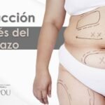 Liposuccion despues del embarazo