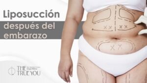 Liposuccion despues del embarazo