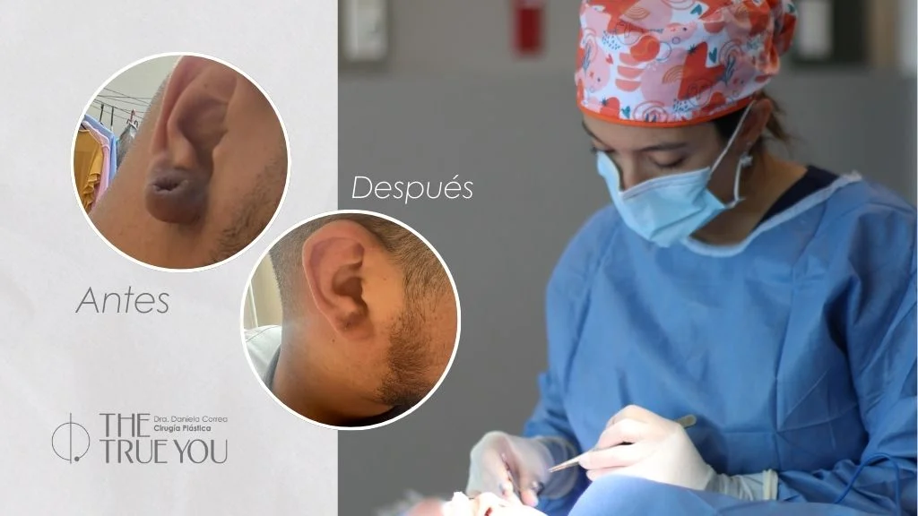 Lobuloplastia en medellin con la Dra danela correa