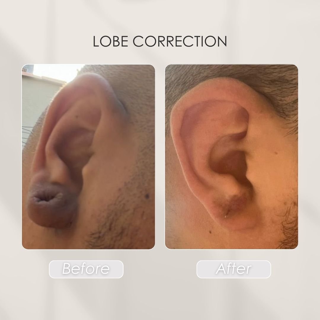 CORRECTION OF LOBULOS - Dra. Daniela Correa Plastic Surgeon Medellín