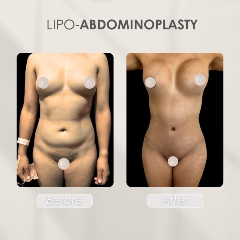lipo abdominoplasty Before and after - Dr. Daniela Correa Plastic Surgeon Medellín