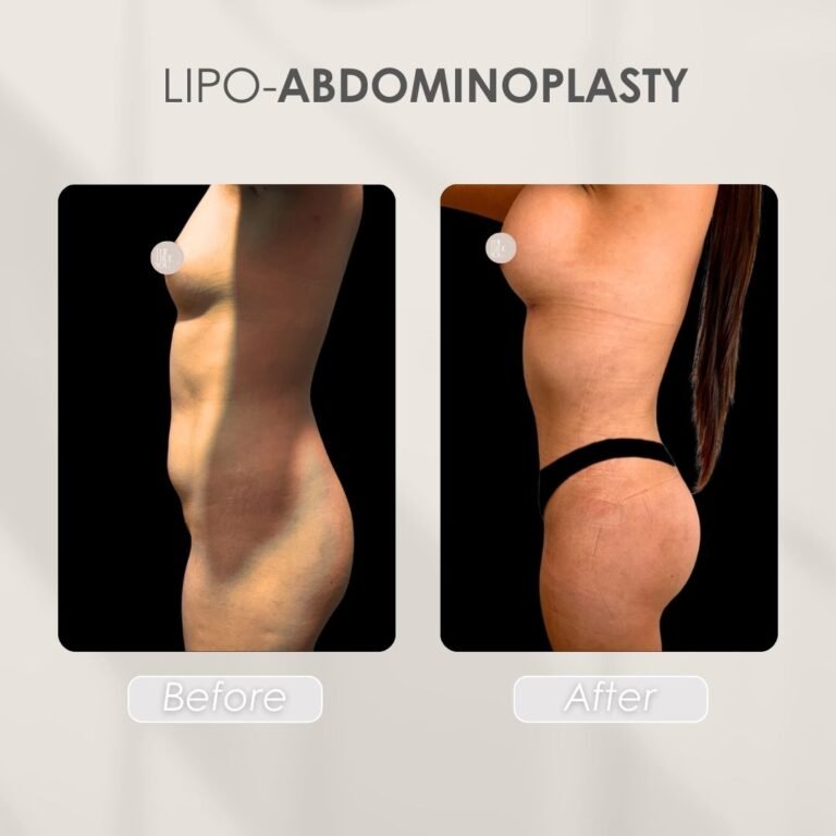 lipo abdominoplasty Before and after - Dr. Daniela Correa Plastic Surgeon Medellín
