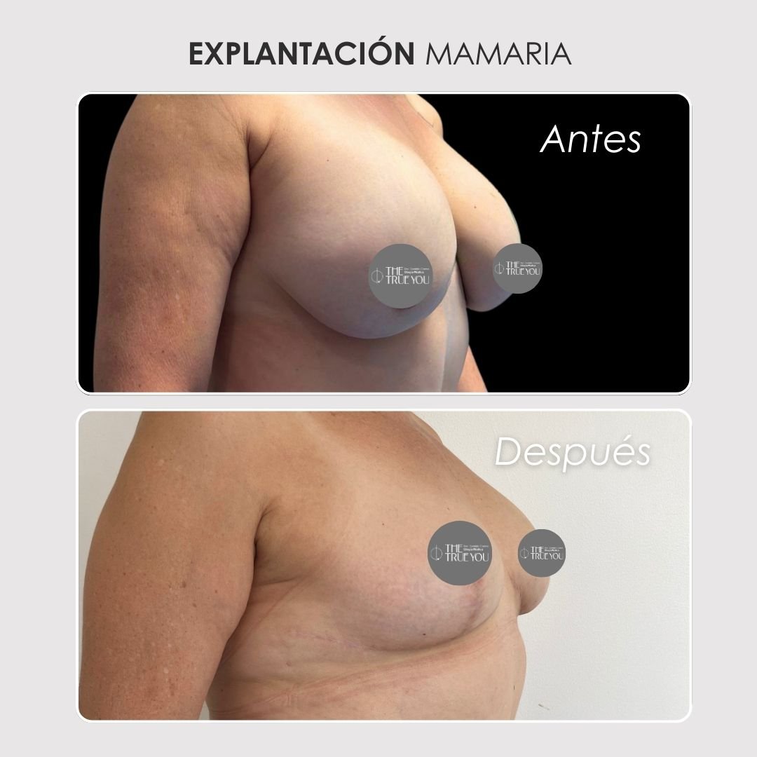 Explantación mamaria Antes y después - Daniela Correa Cirujana