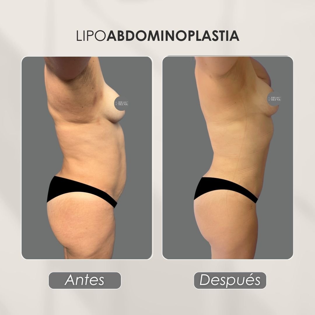 Lipo abdominoplastia Antes y después - Daniela Correa Cirujana