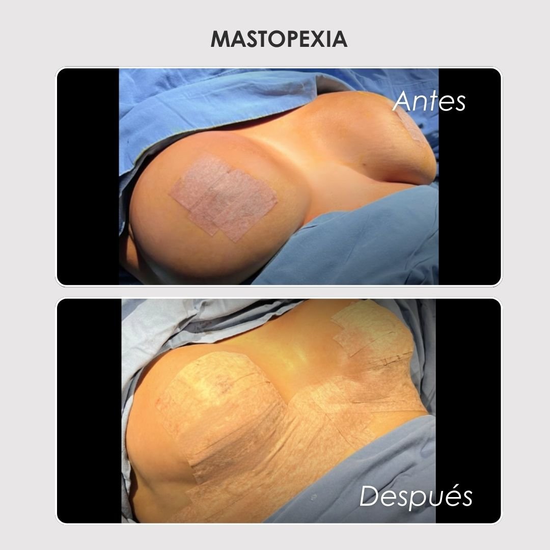 Mastopexia Antes y después - Daniela Correa Cirujana
