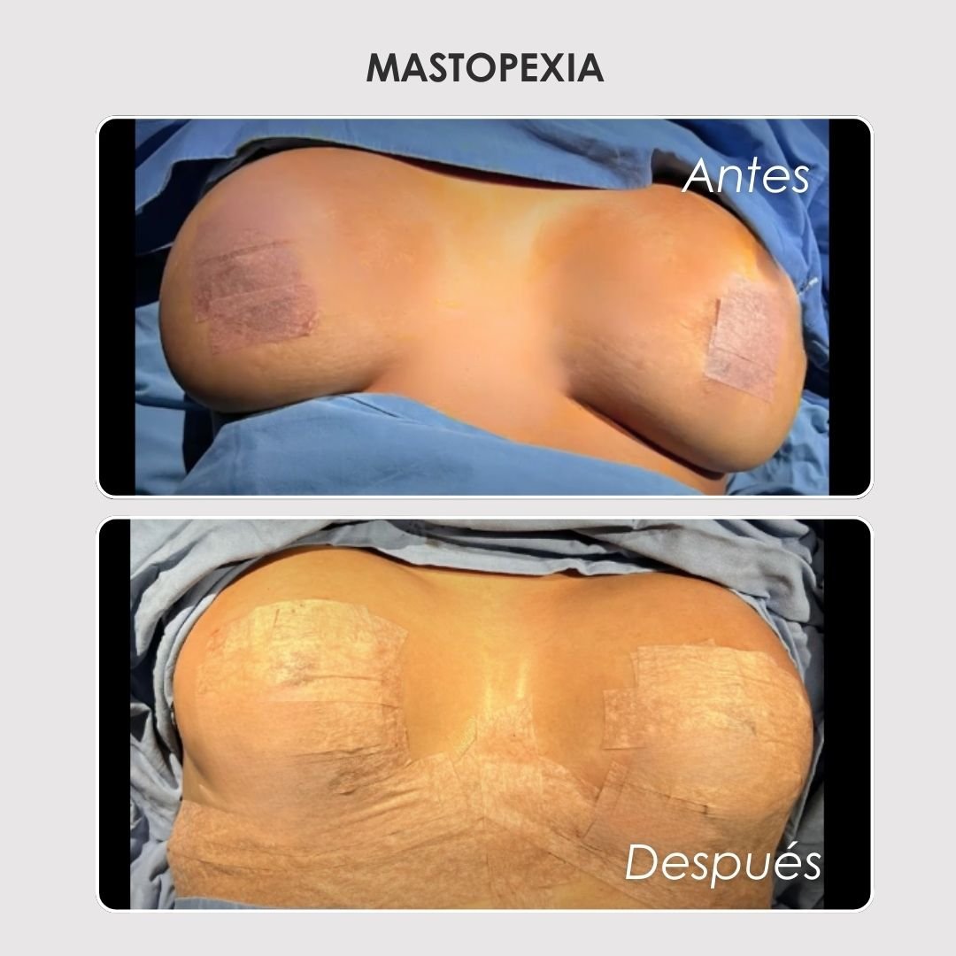 Mastopexia Antes y después - Daniela Correa Cirujana