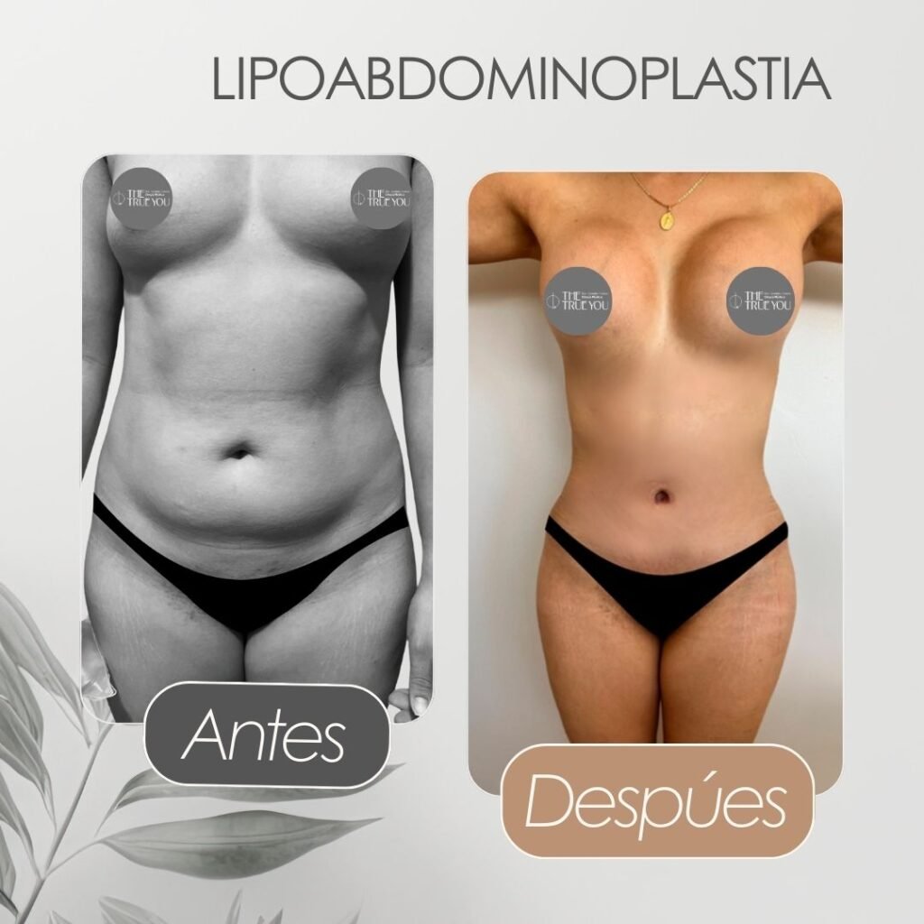 Lipo abdominoplastia Antes y después - Daniela Correa Cirujana
