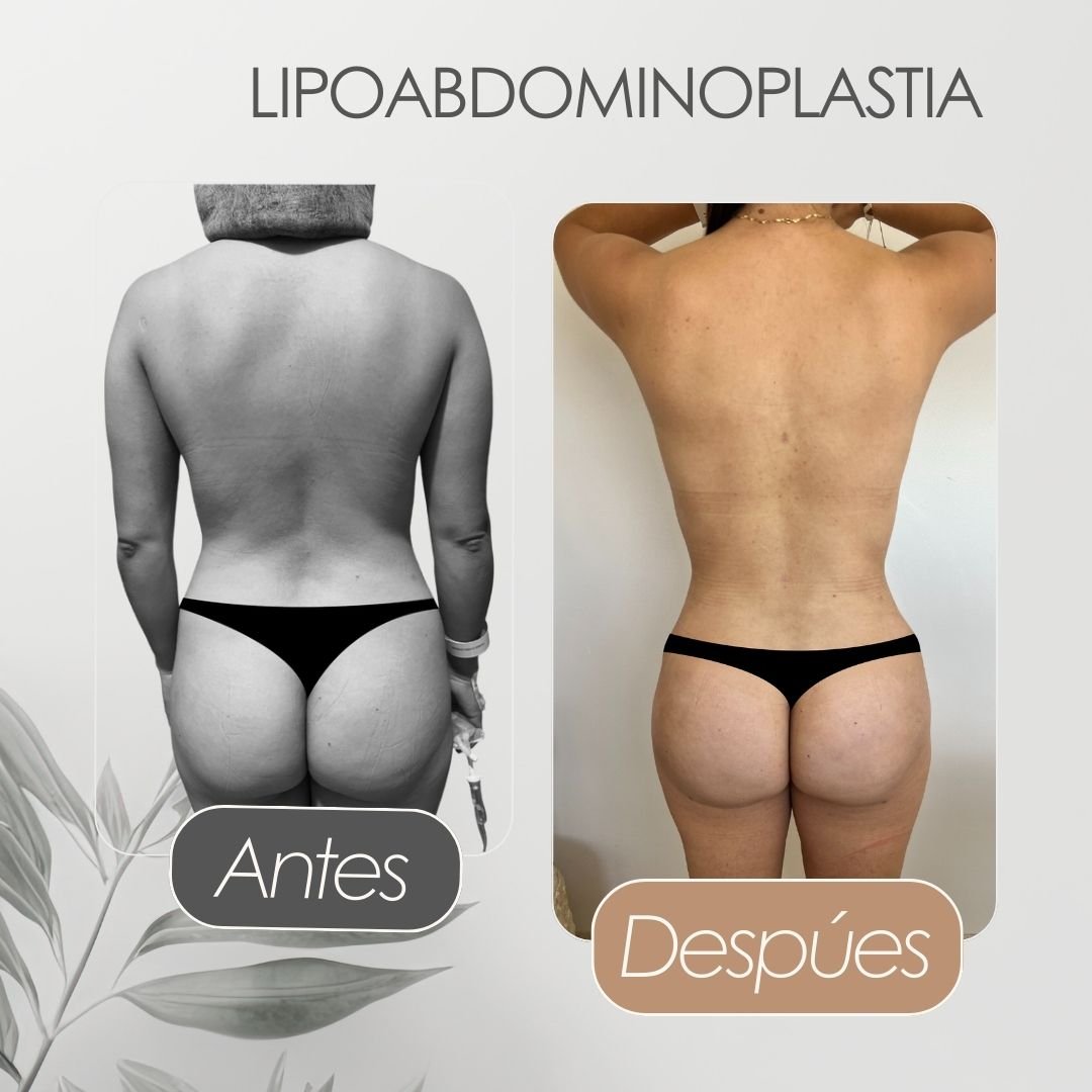 Lipo abdominoplastia Antes y después - Daniela Correa Cirujana