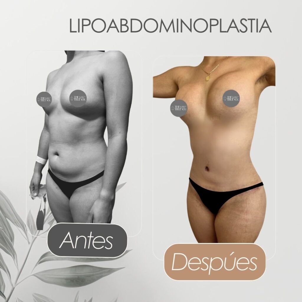 Lipo abdominoplastia Antes y después - Daniela Correa Cirujana