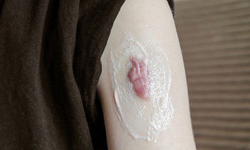 Cicatrices queloide tratamiento con crema - Dra. Daniela Correa - cirujana plástica en Medellín - Crema para los queloides