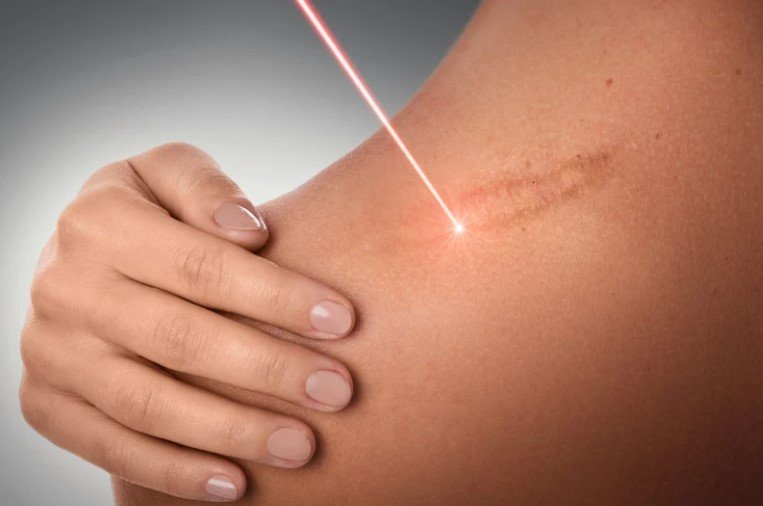 Cicatrices queloide tratamiento con láser - Dra. Daniela Correa - cirujana plástica en Medellín