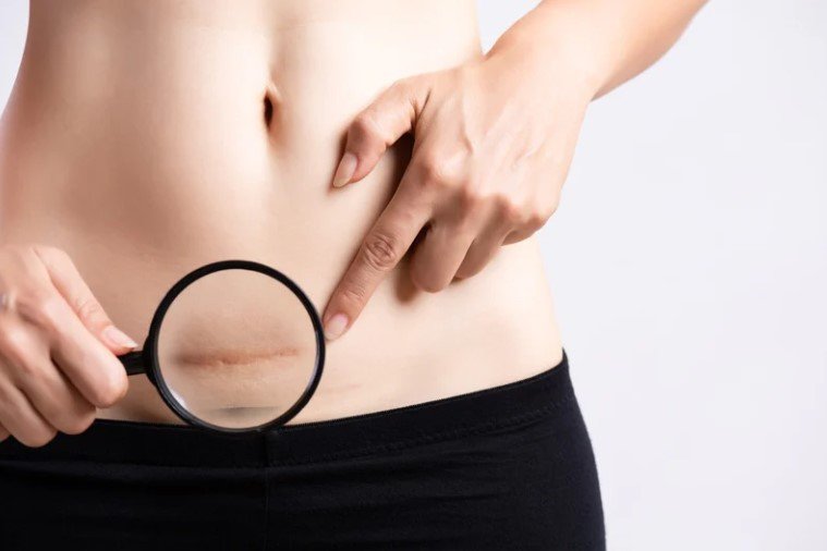 Cicatrices queloide tratamiento con radioterapia - Dra. Daniela Correa - cirujana plástica en Medellín