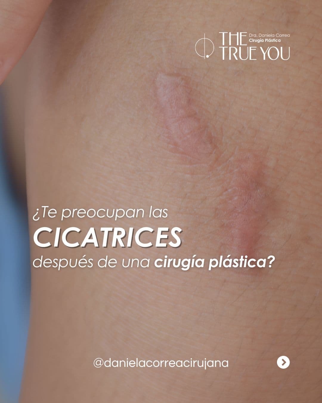 Cirugía para cicatrices queloides en Medellín - Dra. Daniela Correa